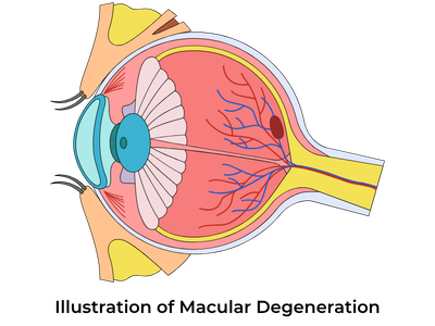 Illustration of age-related macular degeneration
