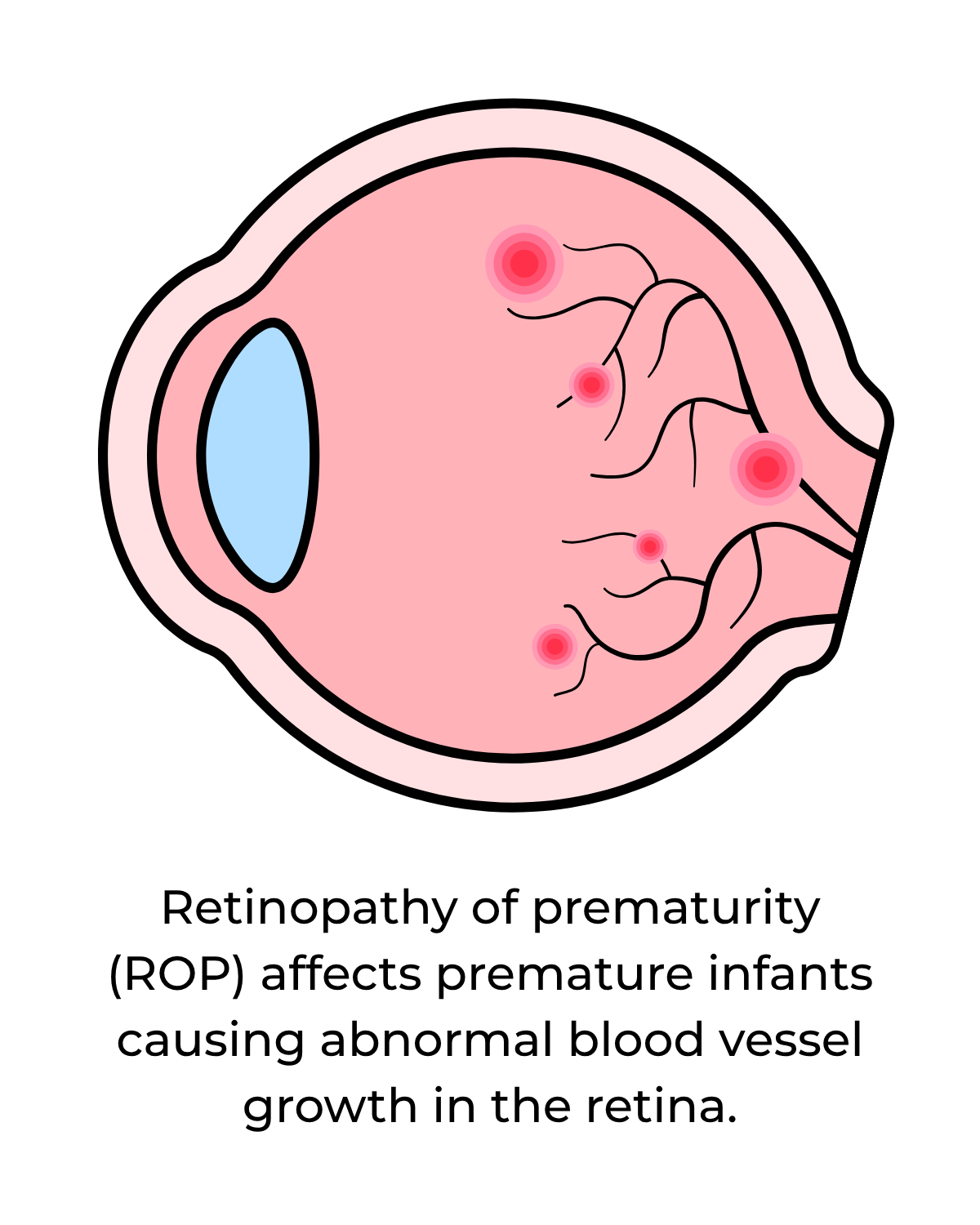 illustrated eye with Retinopathy of prematurity (ROP). TEXT: ROP affects premature infants causing abnormal blood vessel growth in the retina.