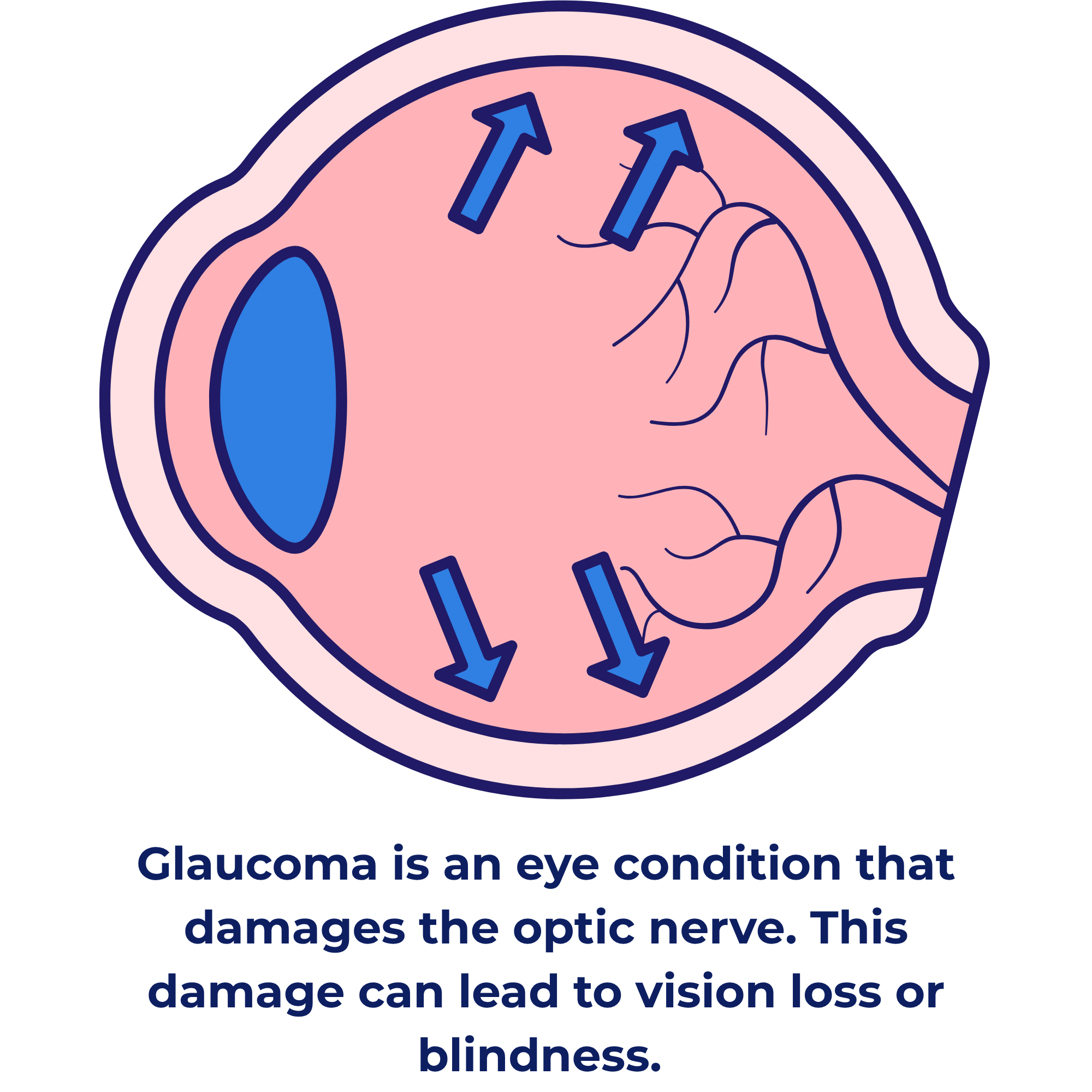 Glaucoma is an eye condition that damages the optic nerve. This damage can lead to vision loss or blindness.